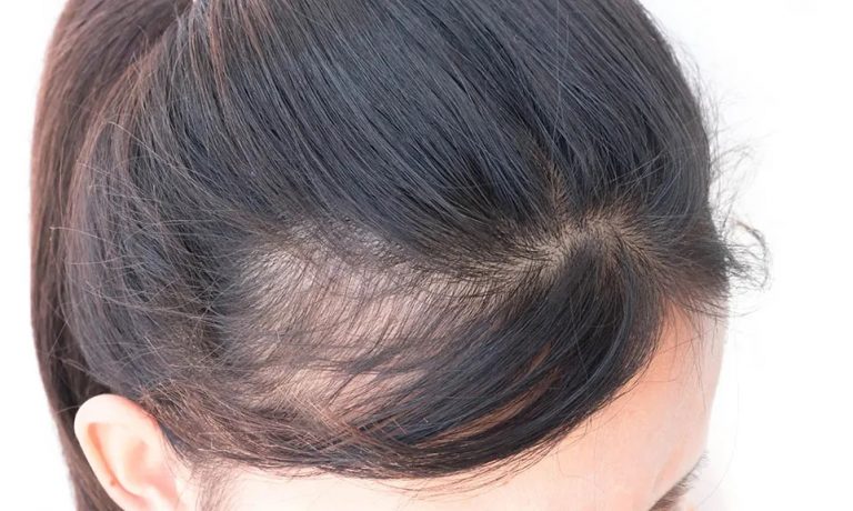 Which Shampoo Can Be Used for Hair Loss?