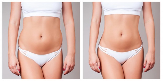3 Important Factors to Consider for a Successful Breast Augmentation Surgery