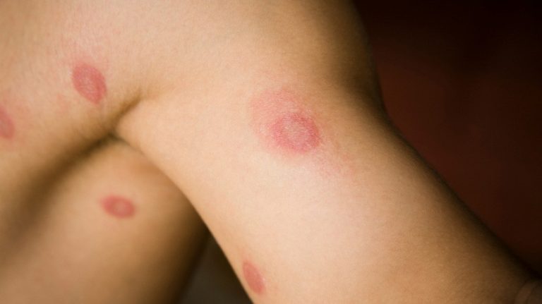 What Tests Are Done To Confirm Ringworm Infection?