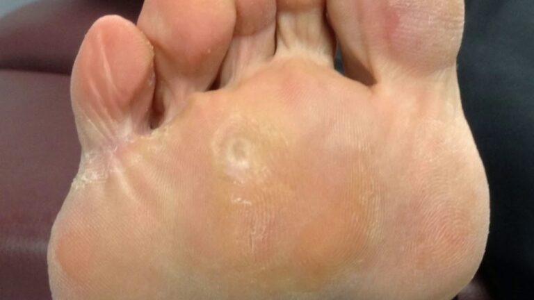 How to qualify for disability porokeratosis feet?