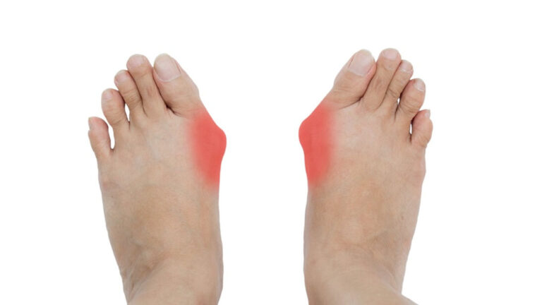 How to Treat a Bunion?