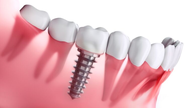 Top 4 Benefits Why You Should Consider Dental Implants
