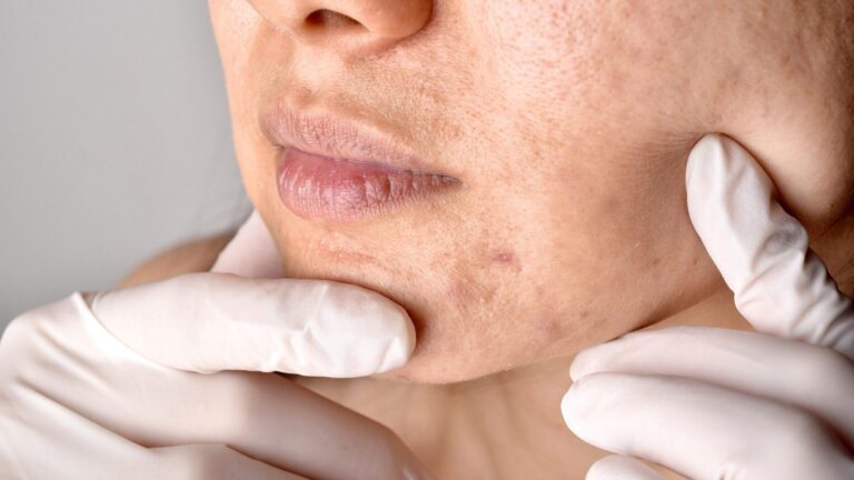 Unlocking the Potential of Pico Laser for Acne Scars