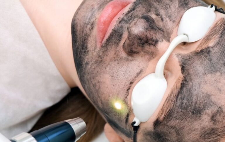 A Deep Dive into Carbon Laser Peel and Its Marvels in Singapore
