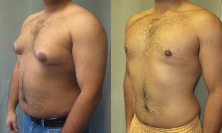 Navigating Confidence: Understanding Gynecomastia Surgery Prices with a Spotlight on Dubai