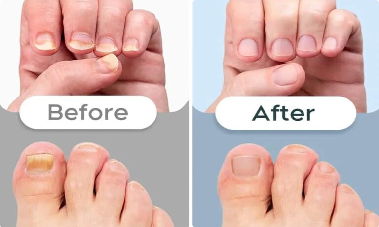 Okita Nail Fungus Light Reviews: The Truth About Laser Therapy for Fungus
