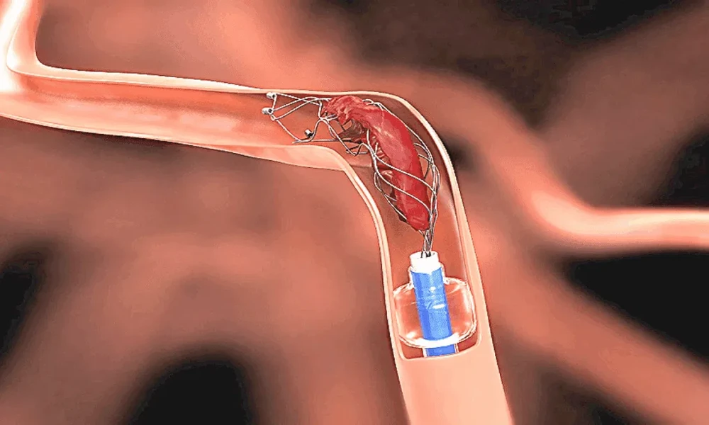 What Does 90 Percent Heart Blockage Mean?